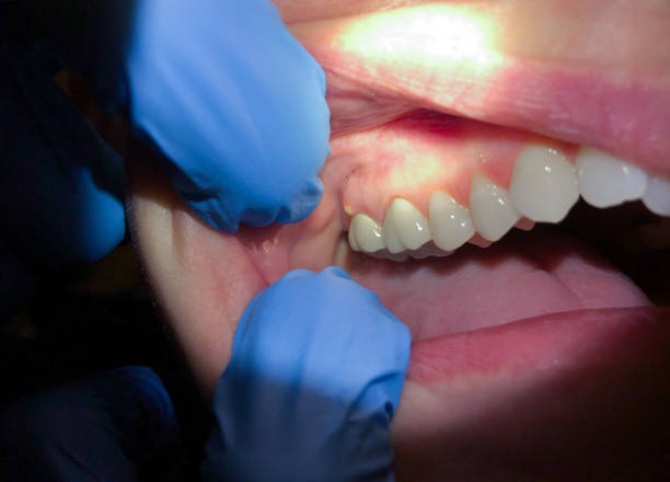 Best Emergency Tooth Extraction in Foreman, AR